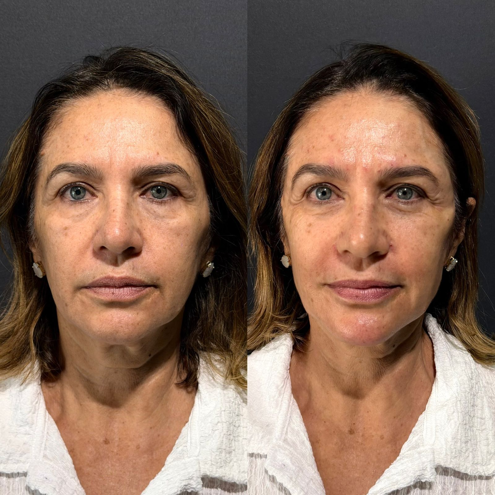 Antes e depois harmonização facial