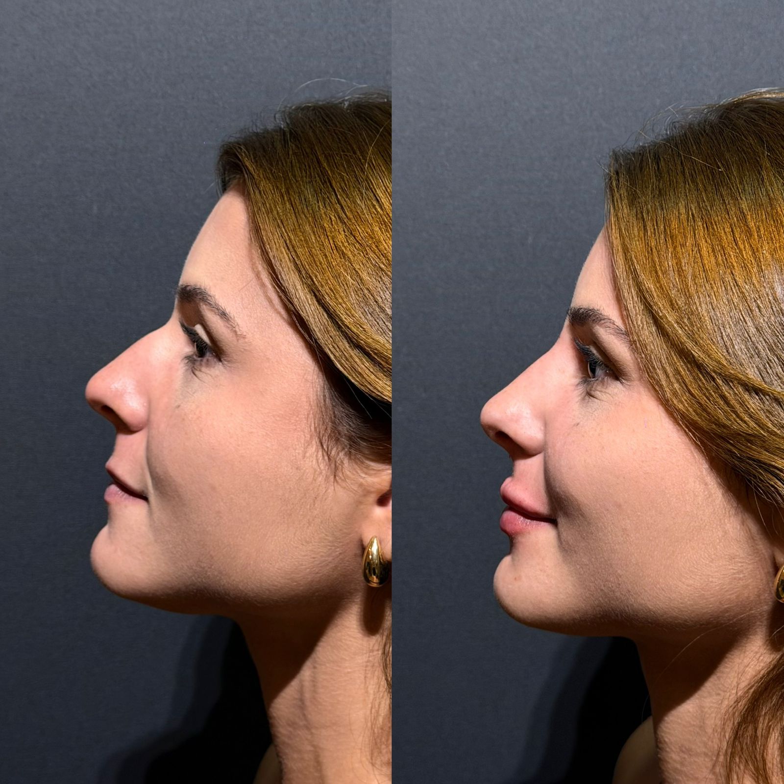 Antes e depois harmonização facial