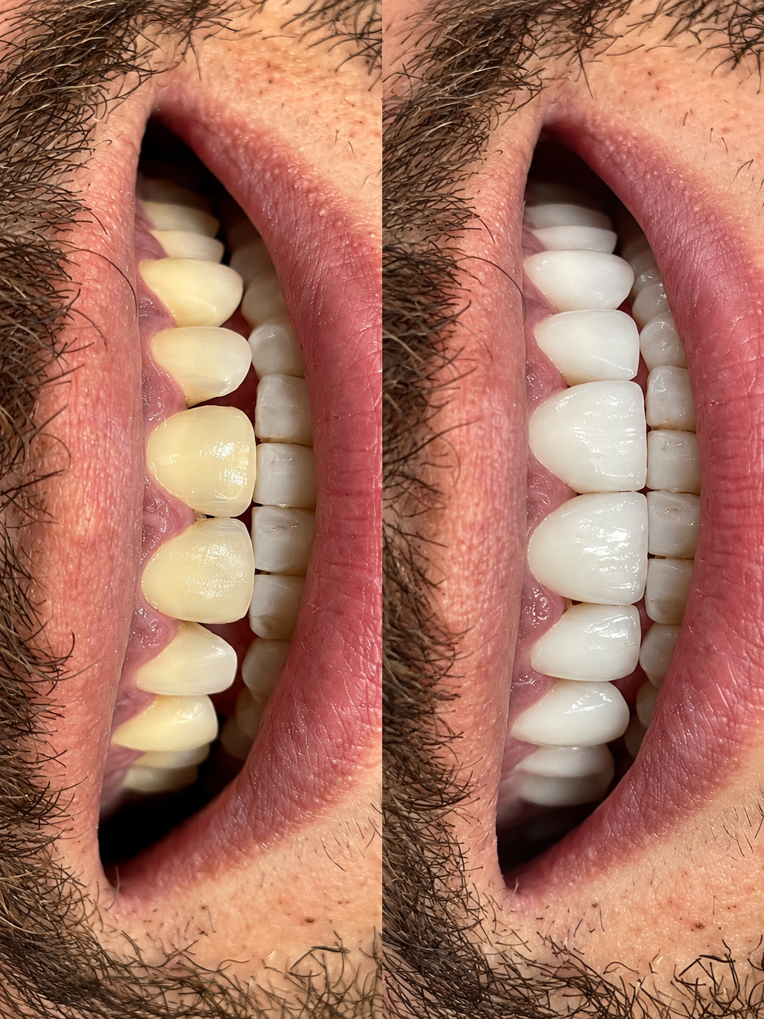 Antes e depois lentes de contato